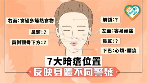 暗瘡 右臉|【暗瘡位置】不同代表什麼？中醫教如何處理及預防